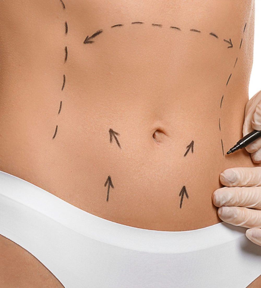 Abdominoplastia