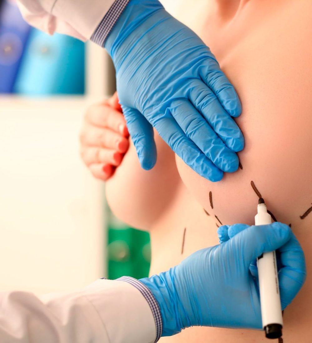 Mamoplastia-01
